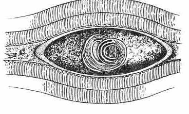 Личинка трихинеллы в мышце